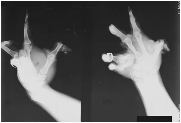 Oceanside teen suffers traumatic hand amputation and severe burns after fireworks device detonates Thursday morning